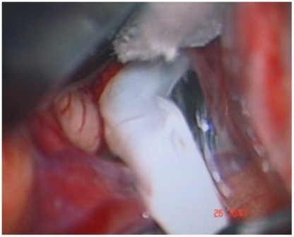 Figure-7: Delivery of a hydatid cyst